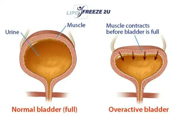 diagram of overactive bladder treatment Dunstable