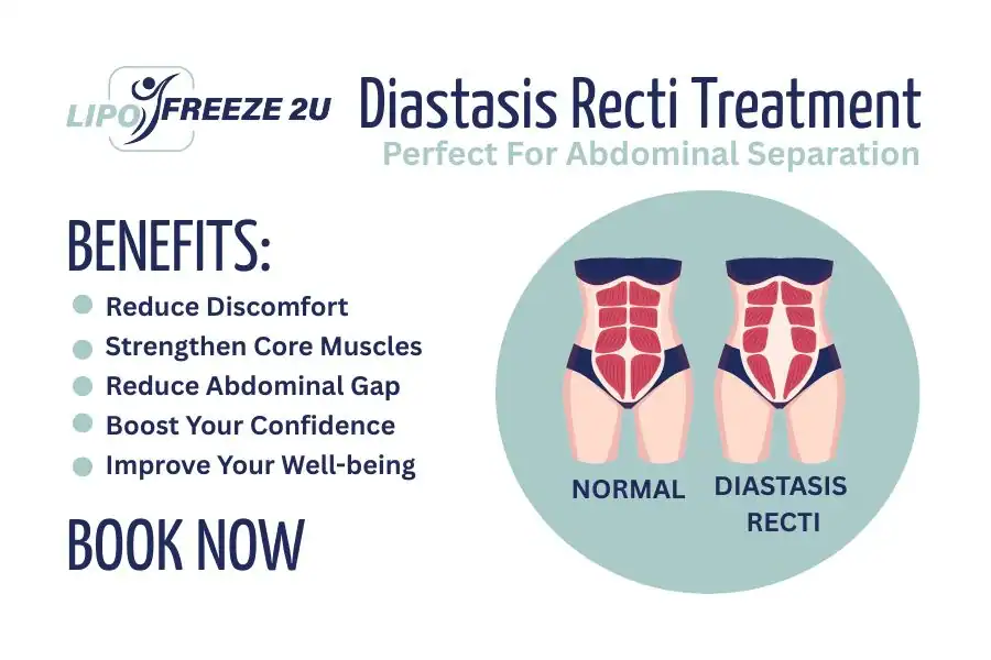 How Long Will It Take to See Improvements in Diastasis Recti Dunstable