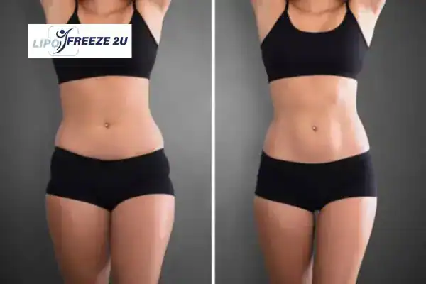 How Can LIPO FREEZE 2U Support Your Post-Pregnancy Body Recovery Dunstable?