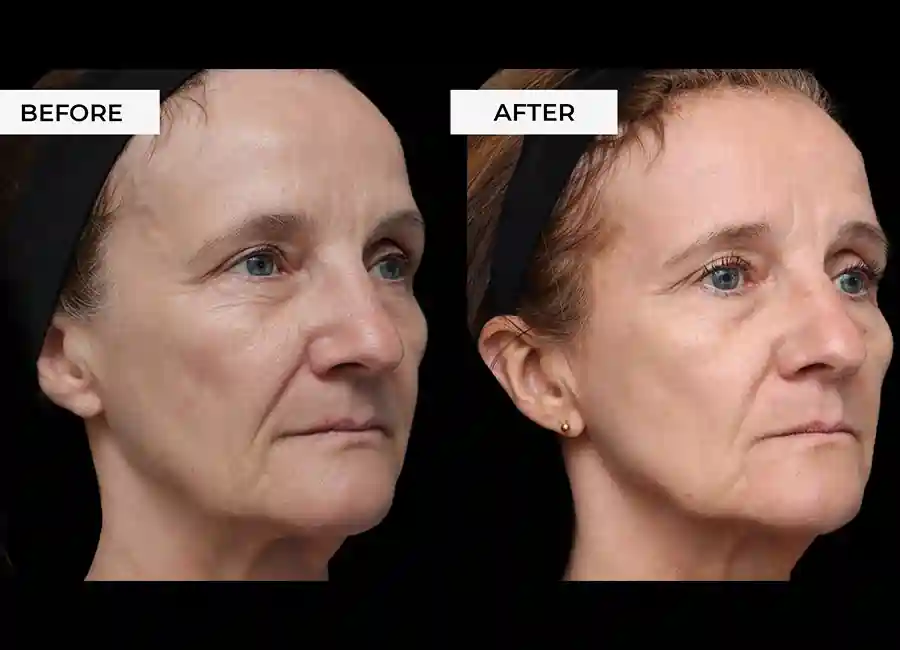 How Many RF Microneedling Sessions Will You Need to See a Difference Dunstable?