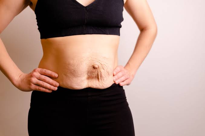 Is Surgery Really the Only Way to Repair Diastasis Recti Dunstable?