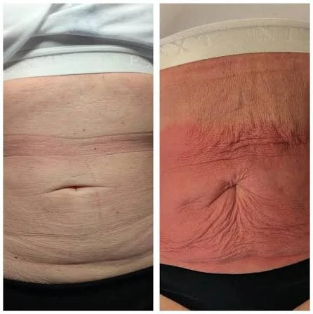 How Does RF Microneedling Improve Crepey, Thin and Uneven Skin Texture Dunstable?