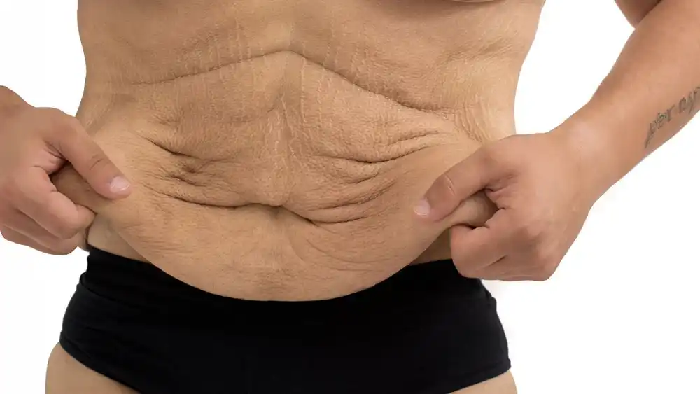 Why Does Weight Loss Medication Leave Some People With Loose or Sagging Skin Dunstable?